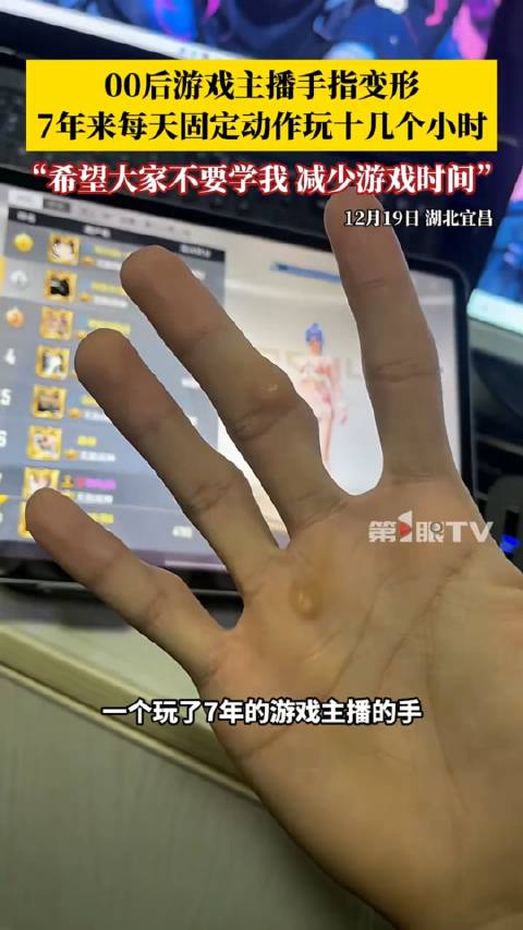 00后做游戏主播7年手指严重变形