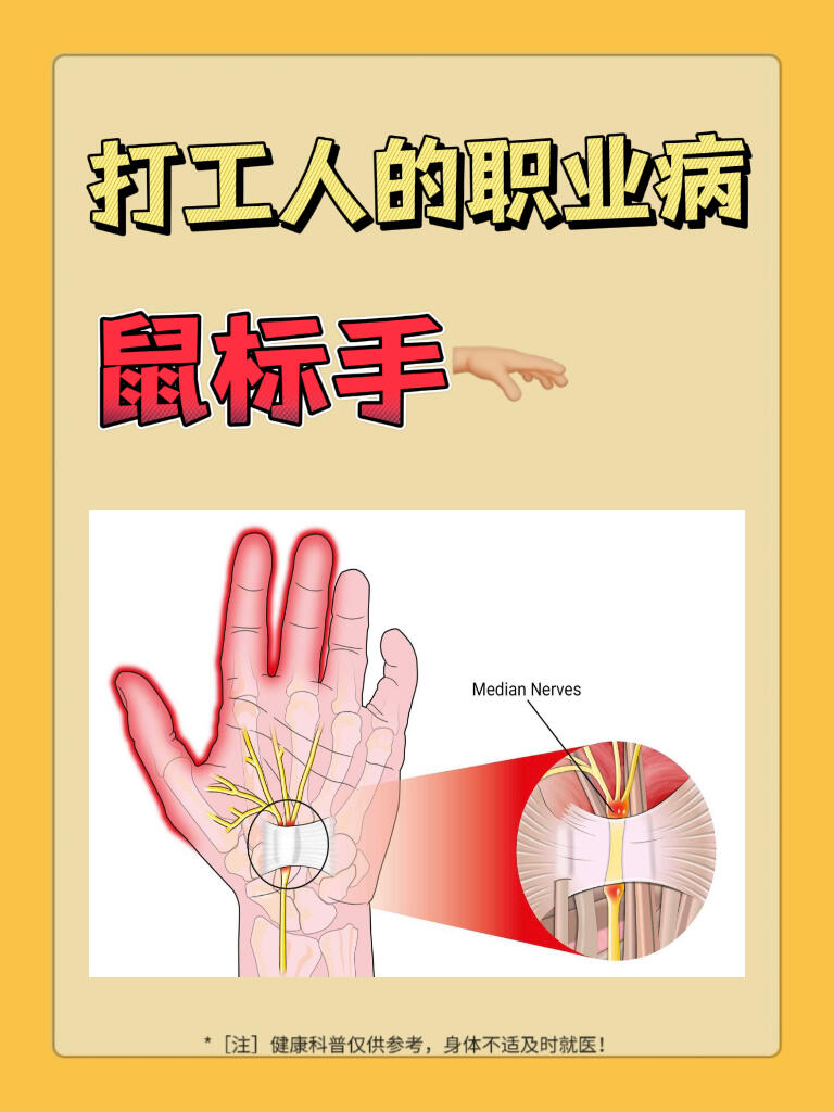 职业病目录新增“鼠标手”