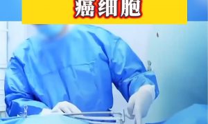 男子确诊肺癌医生一根针冻死癌细胞缩略图